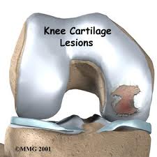 cartilage lesions
